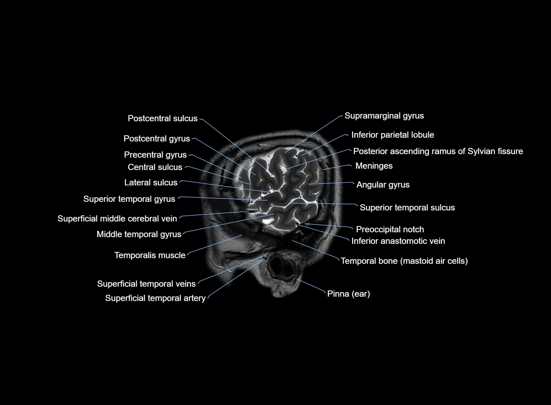 brain sagittal anatomy 3T MRI images -img-00001-00007.webp